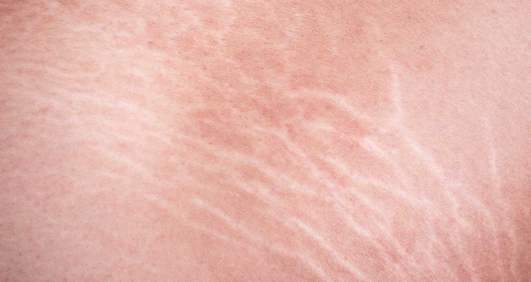 Open Pores/ Surgical Scars/ Stretch Marks