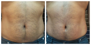 Before and After Tummy Sculpting Sessions