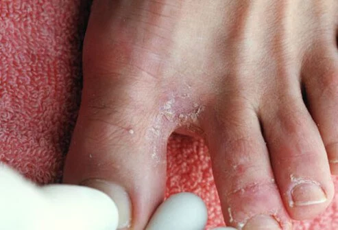 Fungal Skin Diseases & Nail Infection